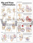 Hip and Knee Inflammations Anatomical Chart